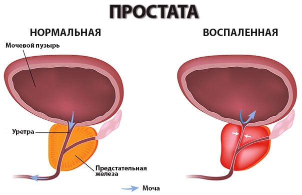 Союз-Аполлон от простатита: инструкция к прибору для лечения, комплектация аппарата