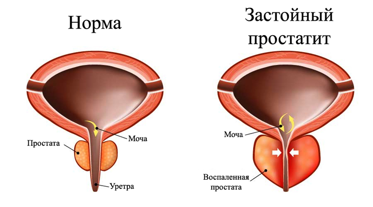 Массаж при простатите в домашних условиях: как делать для лечения, полезен ли