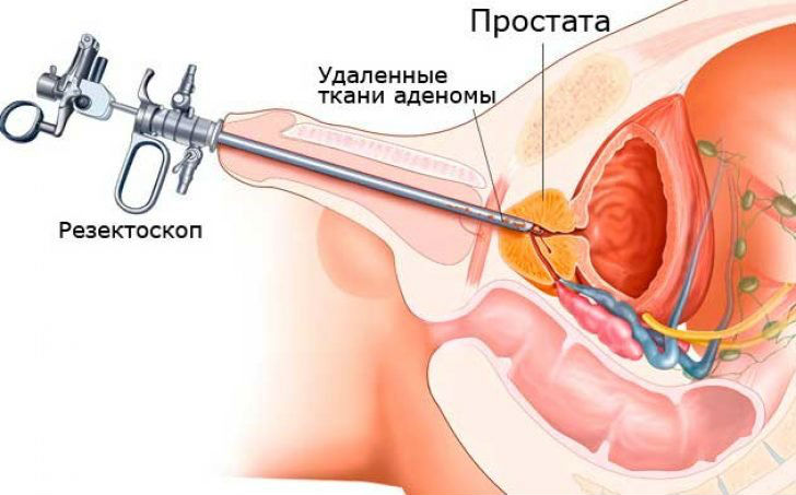 Лазерная вапоризация аденомы простаты: операция по удалению лазером, лечение