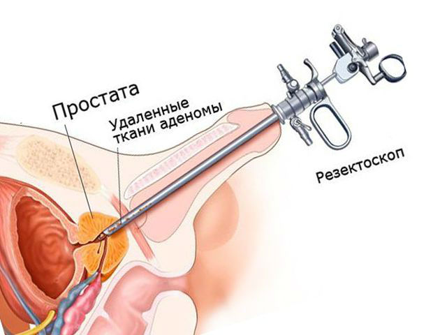 Операция по удалению аденомы простаты (предстательной железы): последствия, отзывы