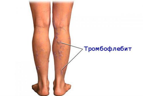 Резекция почки: что это такое, питание в послеоперационный период