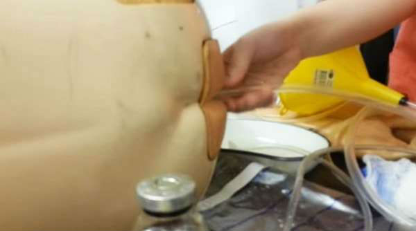 Радикальная цистэктомия мочевого пузыря с кишечной пластикой Радикальная цистэктомия мочевого пузыря с кишечной пластикой