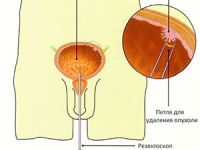 Радикальная цистэктомия мочевого пузыря с кишечной пластикой Радикальная цистэктомия мочевого пузыря с кишечной пластикой