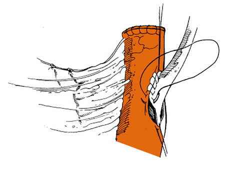 Радикальная цистэктомия мочевого пузыря с кишечной пластикой Радикальная цистэктомия мочевого пузыря с кишечной пластикой