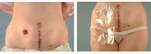 Радикальная цистэктомия мочевого пузыря с кишечной пластикой Радикальная цистэктомия мочевого пузыря с кишечной пластикой