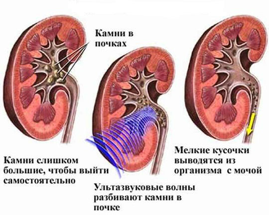 Лечение камней в почках таблетками, разбивающими камни, лекарства и препараты