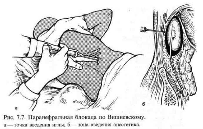 Лечение мочекаменной болезни: препараты, лекарства и таблетки