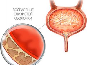 Схема лечения цистита: использование препаратов, соблюдение диеты