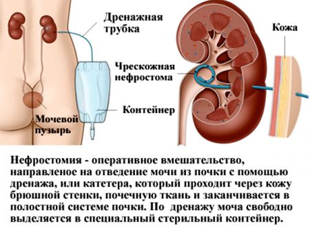Нефростома в почке: операция и удаление дренажа после выздоровления