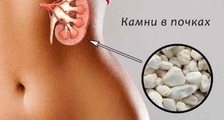 Удаление камня из мочеточника: эндоскопическая операция, через уретру, лазером