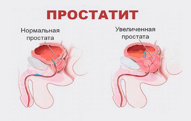 Простатит и потенция: как влияет, средства для восстановления, препараты для лечения импотенции у мужчин
