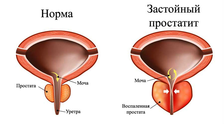 Симптомы простатита: первые признаки у мужчин, диагностика, как проявляется, способы определить