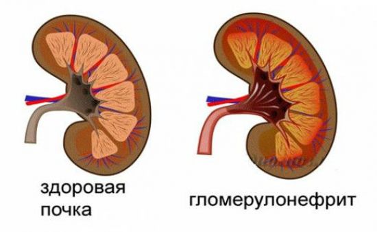 Диагностика болезней почек, основные симптомы заболеваний