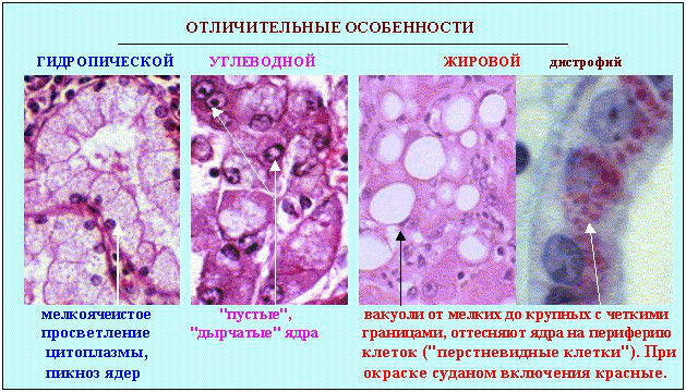 Зернистая дистрофия почки, эпителия извитых канальцев