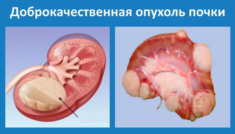 Жжение в области почек: причины, симптомы, диагностика и лечение