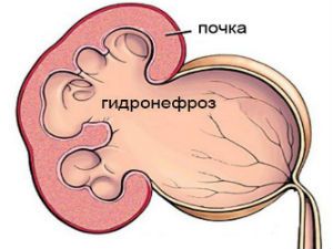 Жидкость в почках: причины и лечение, что это такое