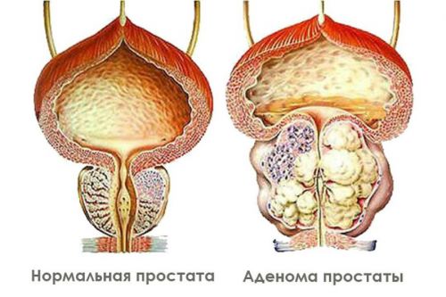 Густая моча как кисель, причины у женщин и мужчин