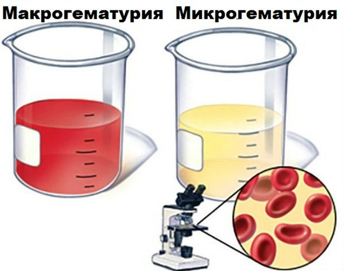 Эритроцитурия: причины у детей, диагностика заболевания