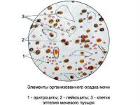 Эритроцитурия: причины у детей, диагностика заболевания