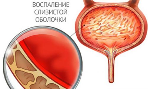 Эритроцитурия: причины у детей, диагностика заболевания