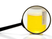 Гиперстенурия: причины, симптомы и диагностика Гиперстенурия: причины, симптомы и диагностика