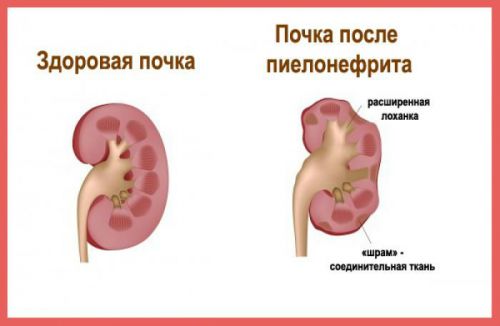 Гломерулосклероз (фокально-сегментарный и диабетический)