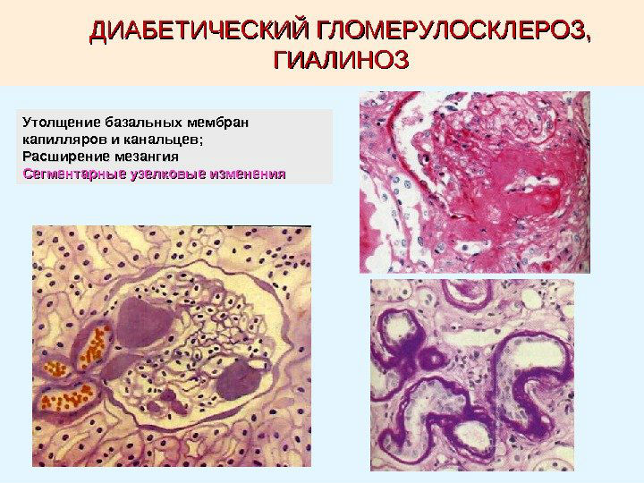 Гломерулосклероз (фокально-сегментарный и диабетический)