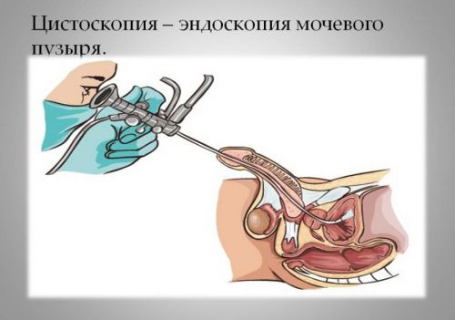 Тянет мочевой пузырь у женщин и мужчин: причины, лечение