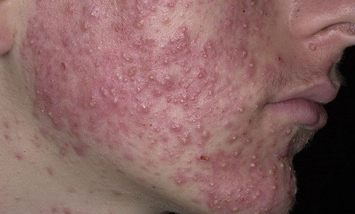 Жир в моче, причины жирных пятен у ребенка и взрослых Жир в моче, причины жирных пятен у ребенка и взрослых