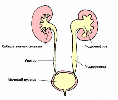 Ишурия парадокса: виды парадоксальной ишурии, ее причины
