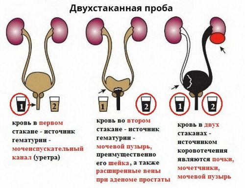 Гематурия: что это такое у мужчин и женщин, причины возникновения у детей