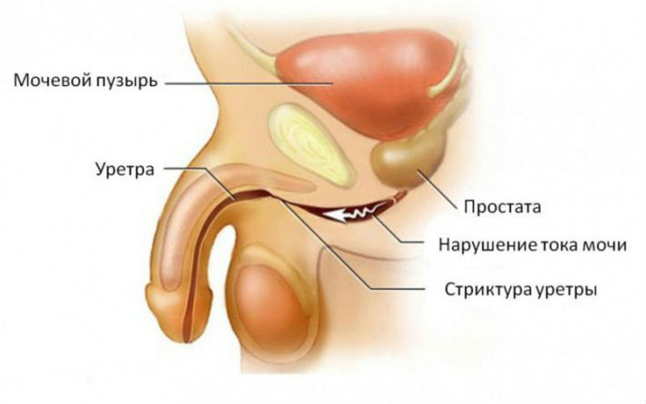 Проблемы с мочеиспусканием у мужчин: причины, лечение, как лечить препаратами