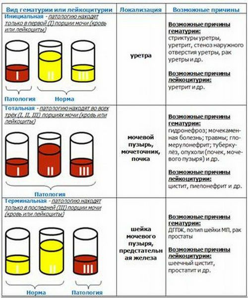 Гной в моче: причины у женщин, диагностика у ребенка