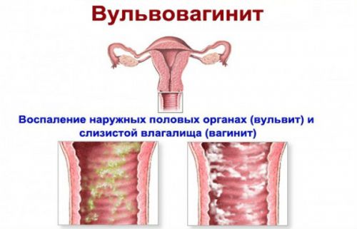 В моче белые сгустки (нити и волокна) у женщин и мужчин