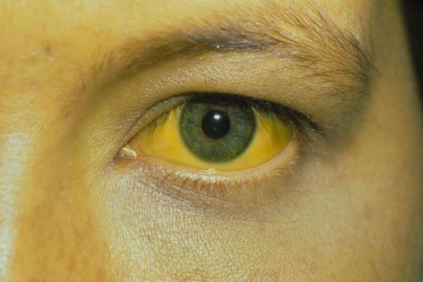 Желчные пигменты в моче: что это значит, норма их содержания Желчные пигменты в моче: что это значит, норма их содержания