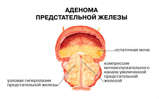 Вялое мочеиспускание у мужчин и женщин (нет напора), лечение народными средствами