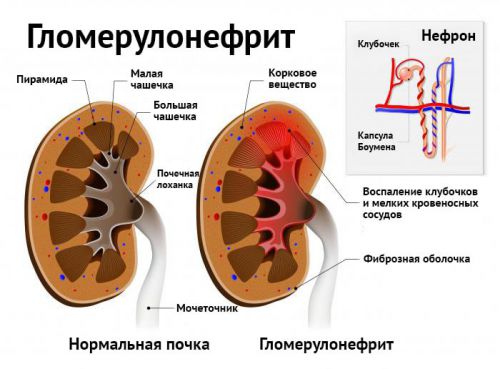 Болят почки после антибиотиков, могут ли они болеть вследствие приема