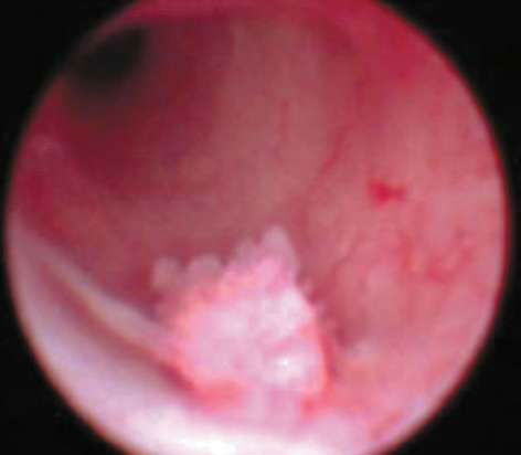 Мало мочи при мочеиспускании, причины малого количества у женщин и ребенка Мало мочи при мочеиспускании, причины малого количества у женщин и ребенка