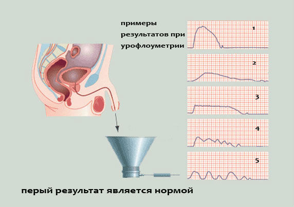 Прерывистое мочеиспускание у мужчин и женщин, его причины