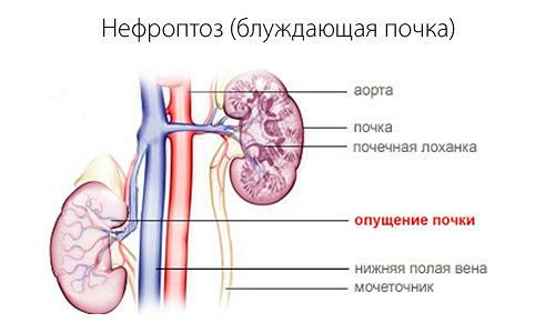 Как болят почки у мужчин: симптомы и признаки больных почек