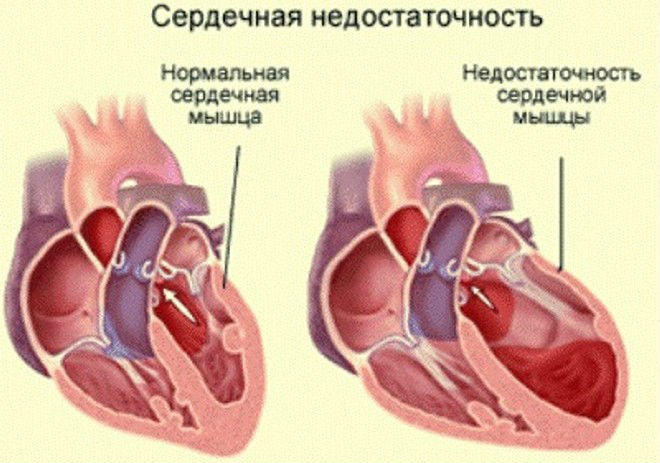 Олигурия: симптомы, лечение, причины, что это такое у женщин и детей
