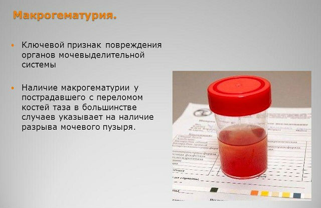 Моча цвета мясных помоев, при каких заболеваниях это наблюдается