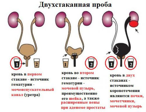 Моча с кровью у женщин: причины сгустков крови, что это означает, лечение