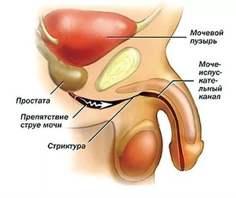 Мочевой пузырь не опорожняется полностью у женщин и мужчин: причины, лечение