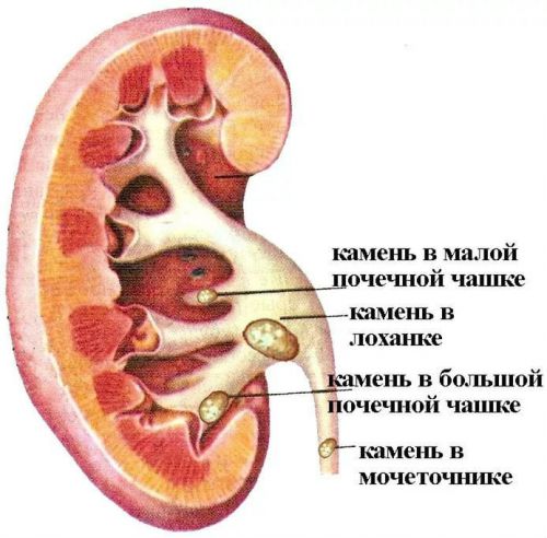 Тянет почки: что делать, причины тянущей боли в области почек