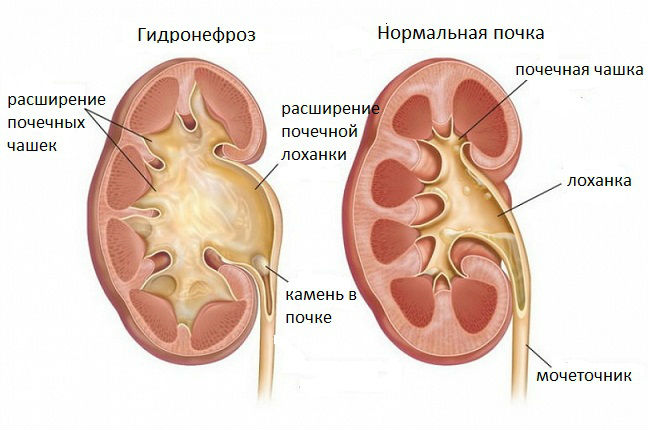 Почему болят почки у человека, причины боли в области почек