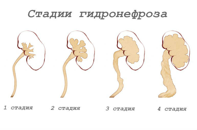 Болят почки: симптомы и лечение, чем лечить ноющие боли