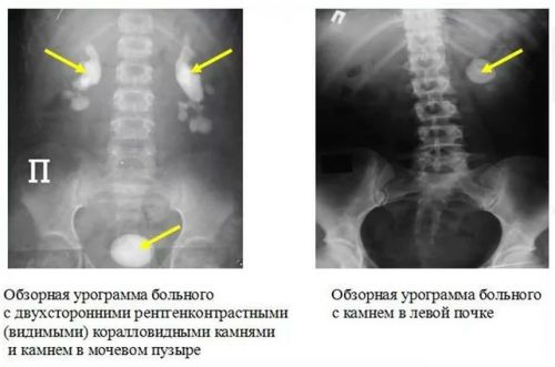 Рентген почек с контрастным веществом, подготовка к рентгенографии