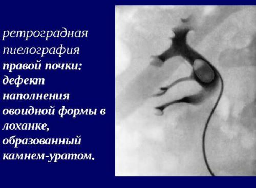 Рентген почек с контрастным веществом, подготовка к рентгенографии