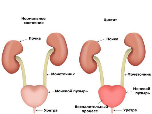 Затрудненное мочеиспускание у мужчин и женщин: причины, лечение